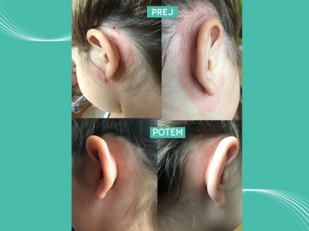 Izkušnja stranke: Težave s kožo za ušesi