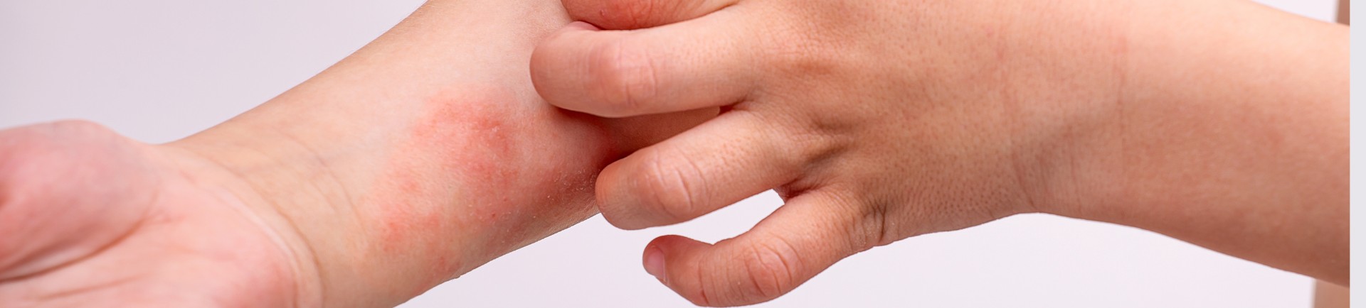DERMATITIS IN EKCEMI