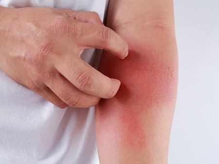 Dermatitis and eczema